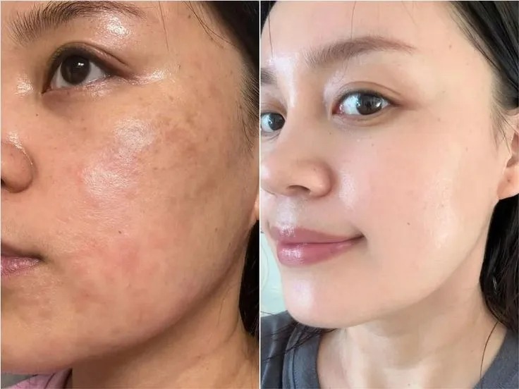 before after testimoni skin care dragon blood