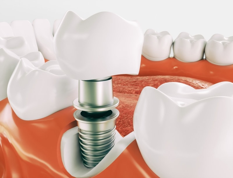 Memahami Implan Gigi: Apa itu implan gigi, manfaatnya, dan Apakah Cocok untuk Anda?