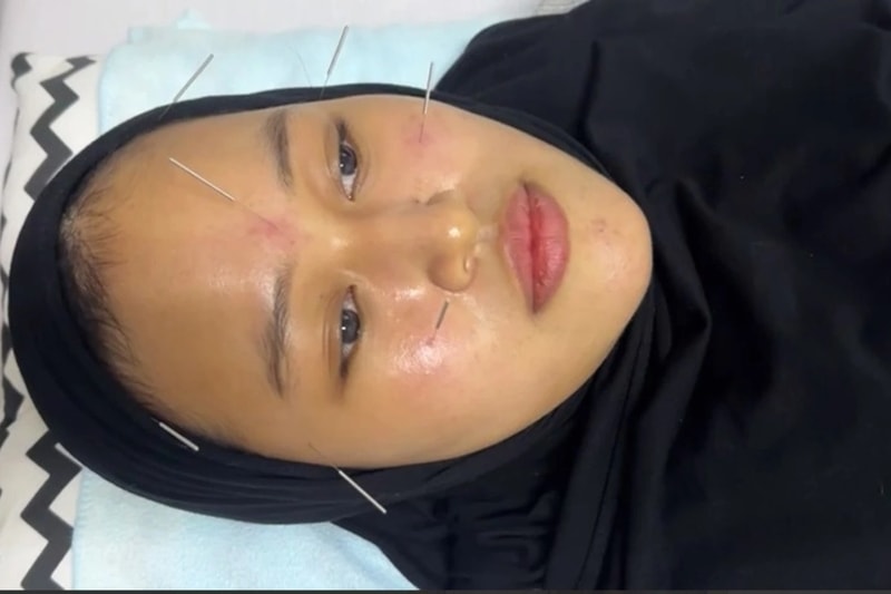 Akupunktur Kecantikan di Klinik Shinse Ren Ai