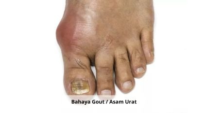 Sendi Bengkak, Merah, dan Terasa Panas? Kenali Tanda Awal Asam Urat