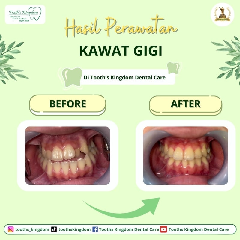 behel / kawat gigi
