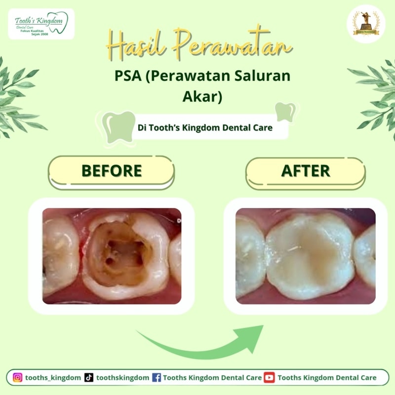 Perawatan saluran akar gigi