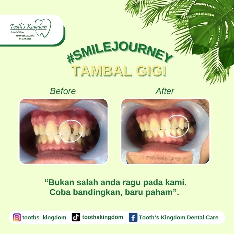 penambalan gigi / tambal gigi