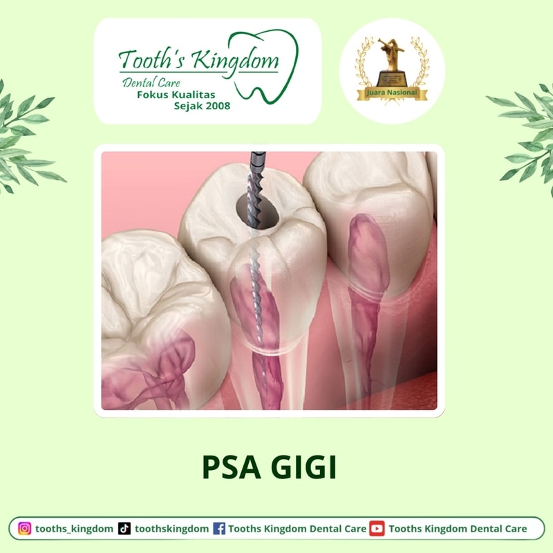 Perawatan saluran akar gigi