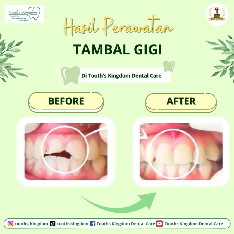 penambalan gigi / tambal gigi