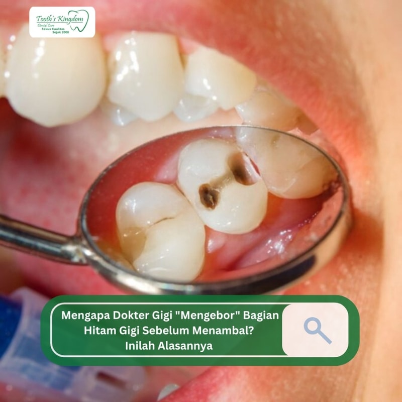 Mengapa Dokter Gigi "Mengebor" Bagian Hitam Gigi Sebelum Menambal? Inilah Alasannya