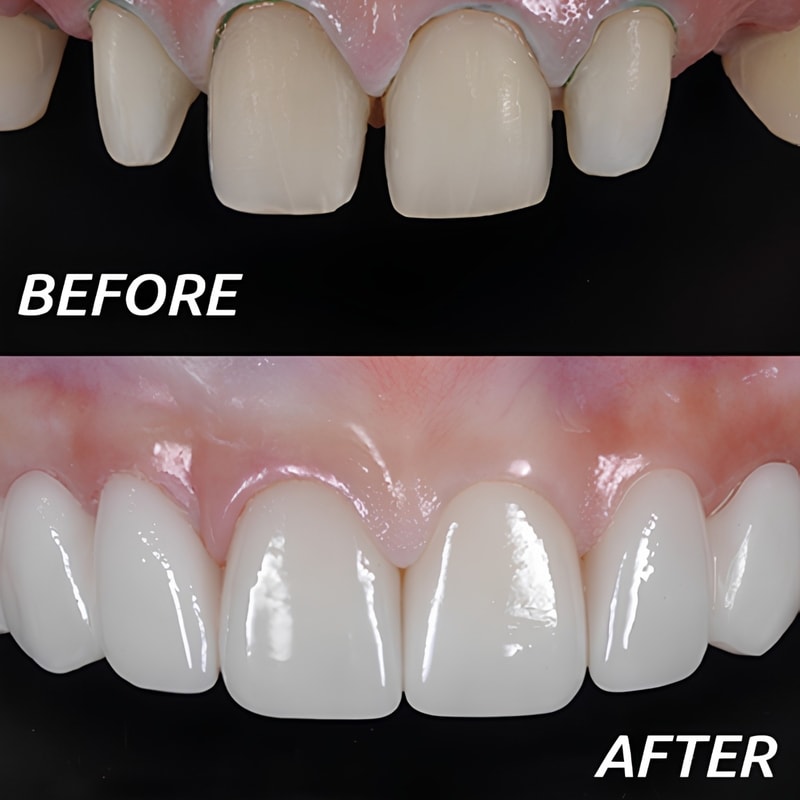 before after veneer